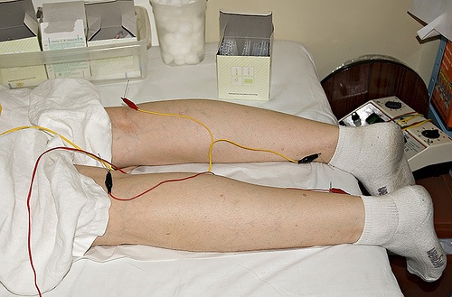 acupuncture-treatment-legs-pain-alternative