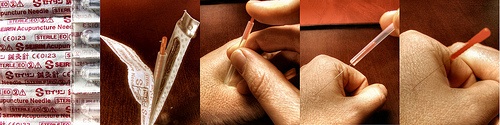acupuncture-needles-pain-treatment-close-up acupuncture-needles-pain-treatment-close-up