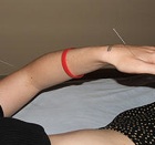 acupuncture-needles-on-hand-and-arm