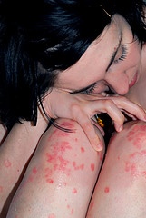 skin-rash-psoriasis-beauty-woman-knees-calves